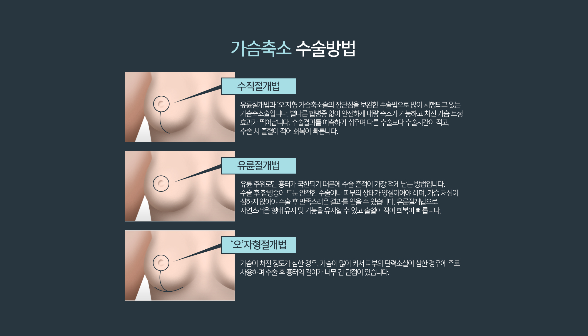 가슴축소 수술방법